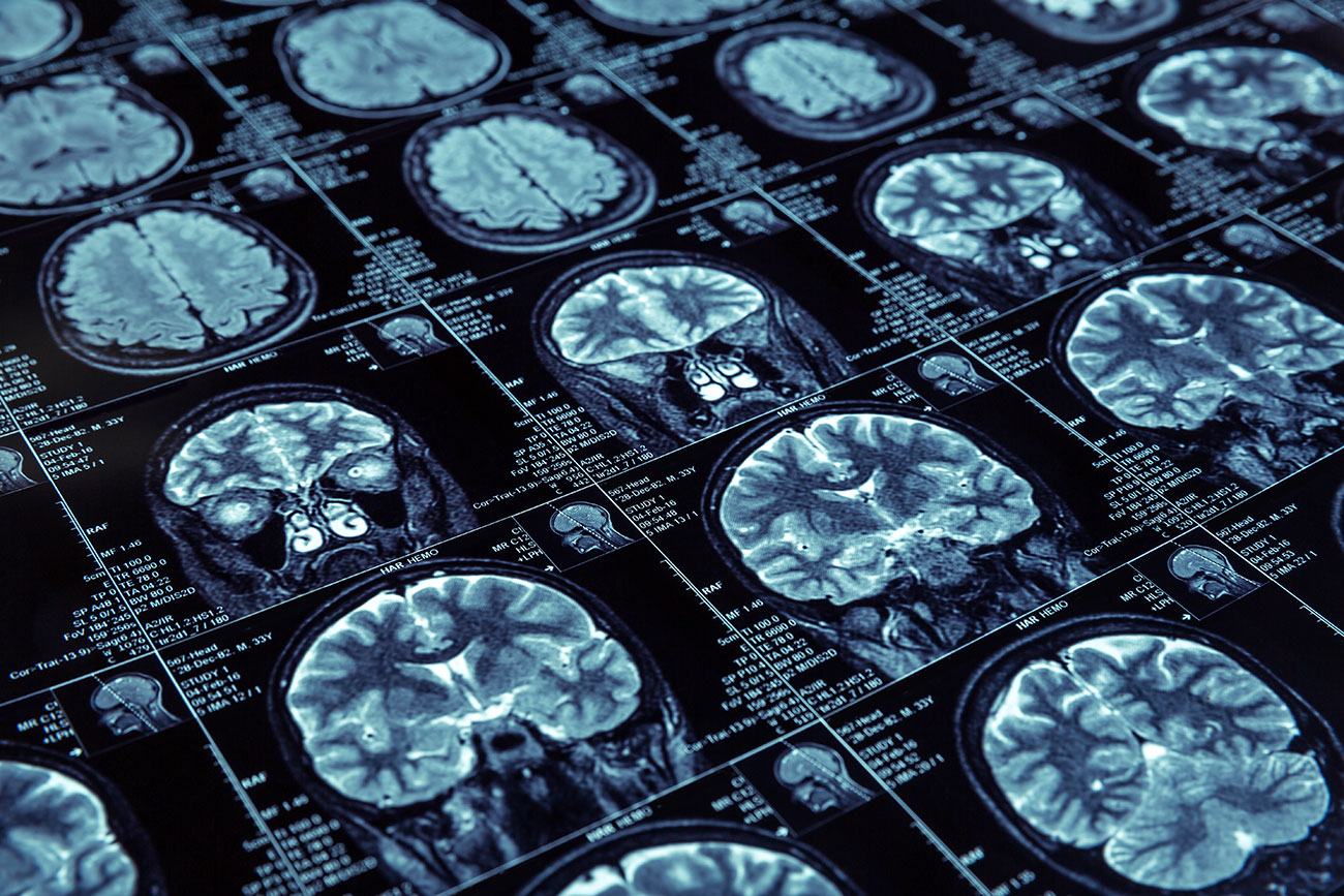 MRI-images-of-the-brain-stages-of-Alzheimers-disease