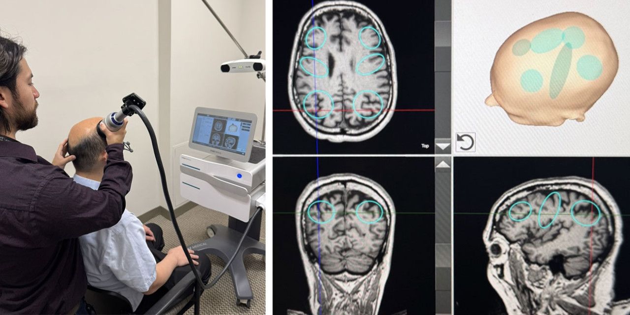 Milestone: Study protocol for the first TPS-Parkinson’s trial in the USA published