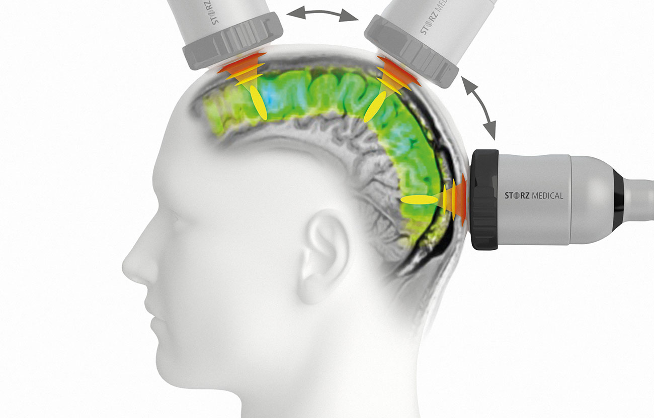 transcranial-pulse-stimulation-new-paths-in-alzheimers-therapy